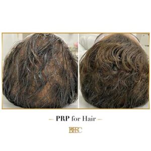 PRP-HAIR