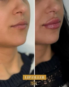 Lip Fillers in Sharjah