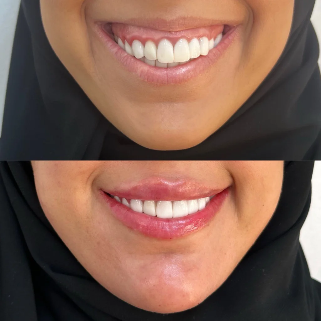 Gummy Smile Botox