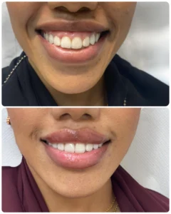 Gummy Smile Botox