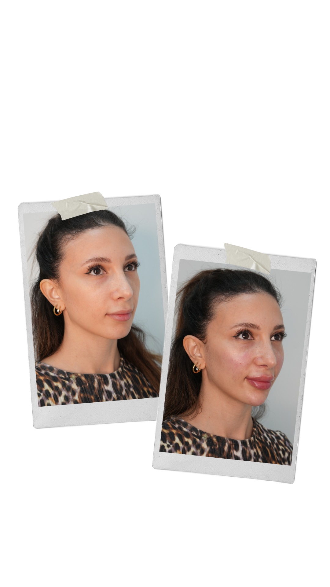 Skin Boosters Sharjah