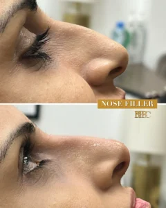 Nose Fillers Sharjah