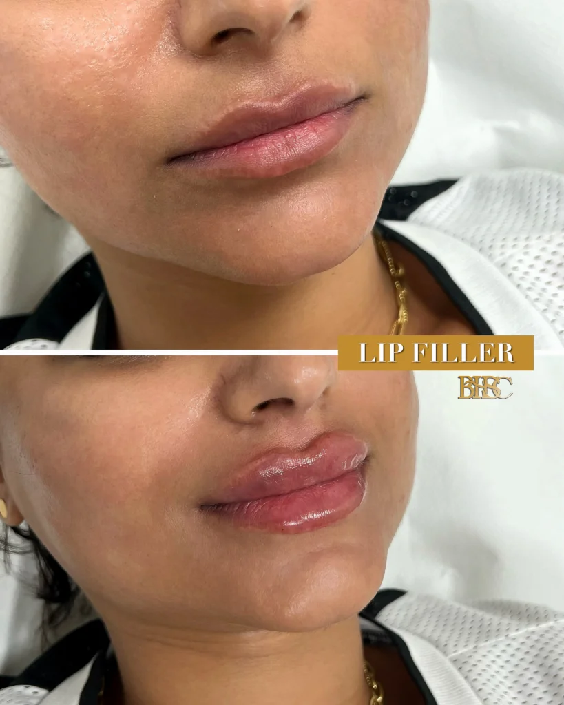 Lip Fillers in Sharjah