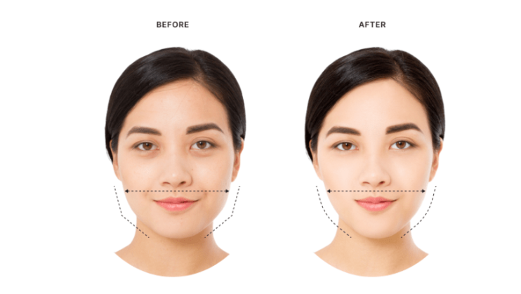 Masseter Botox