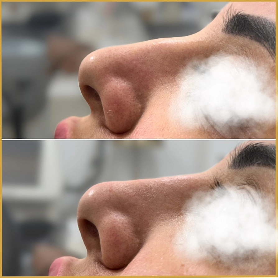 Nose Fillers Sharjah