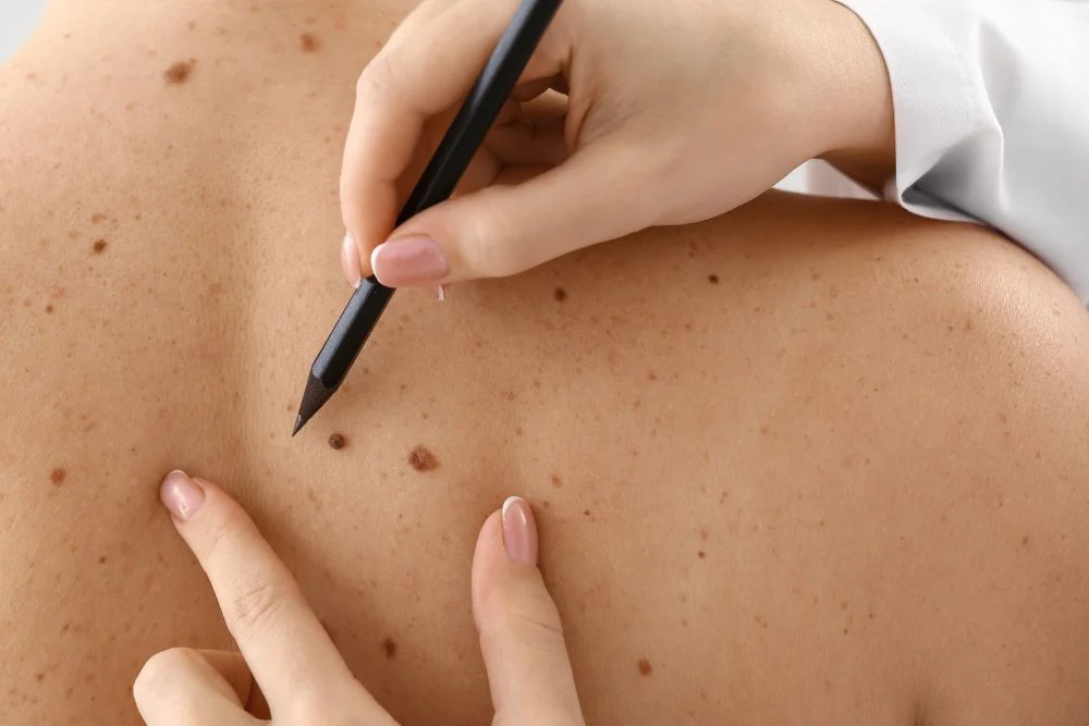 Tag Wart Removal