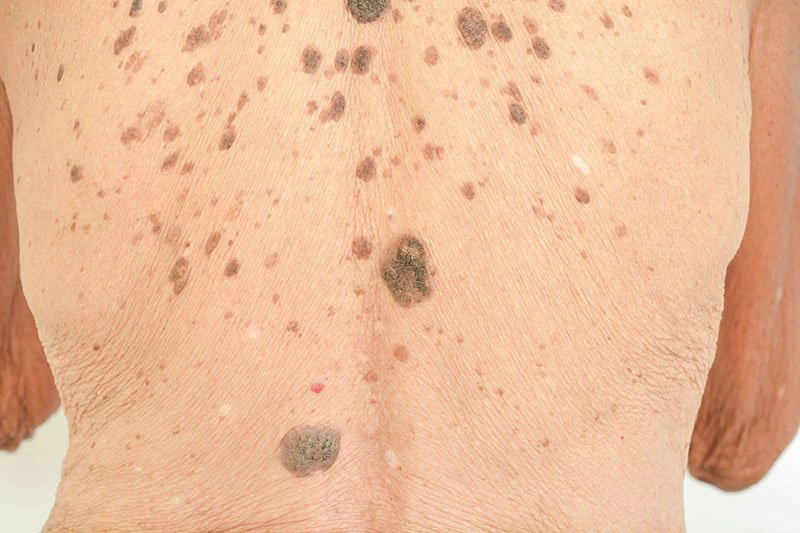 Tag Wart Removal in Sharjah