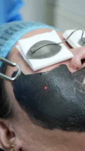 Carbon Laser Facial in Sharjah
