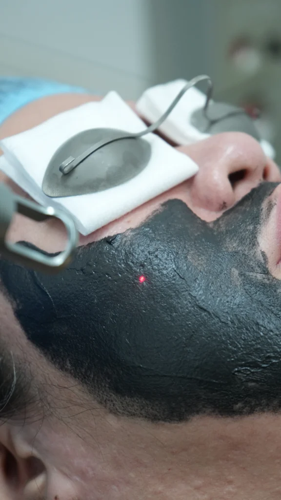 Carbon Laser Facial in Sharjah