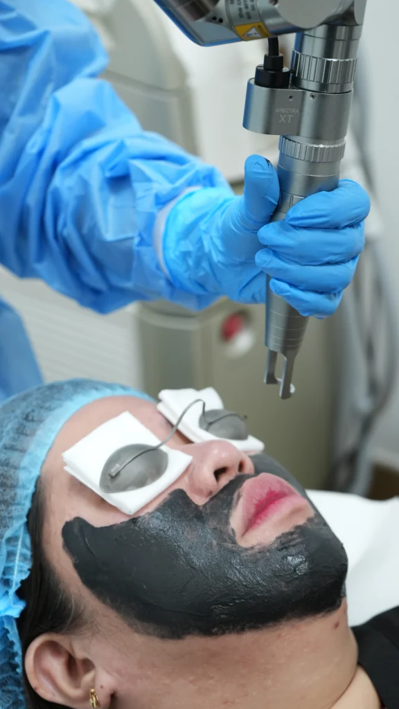 Carbon Laser Facial in Sharjah