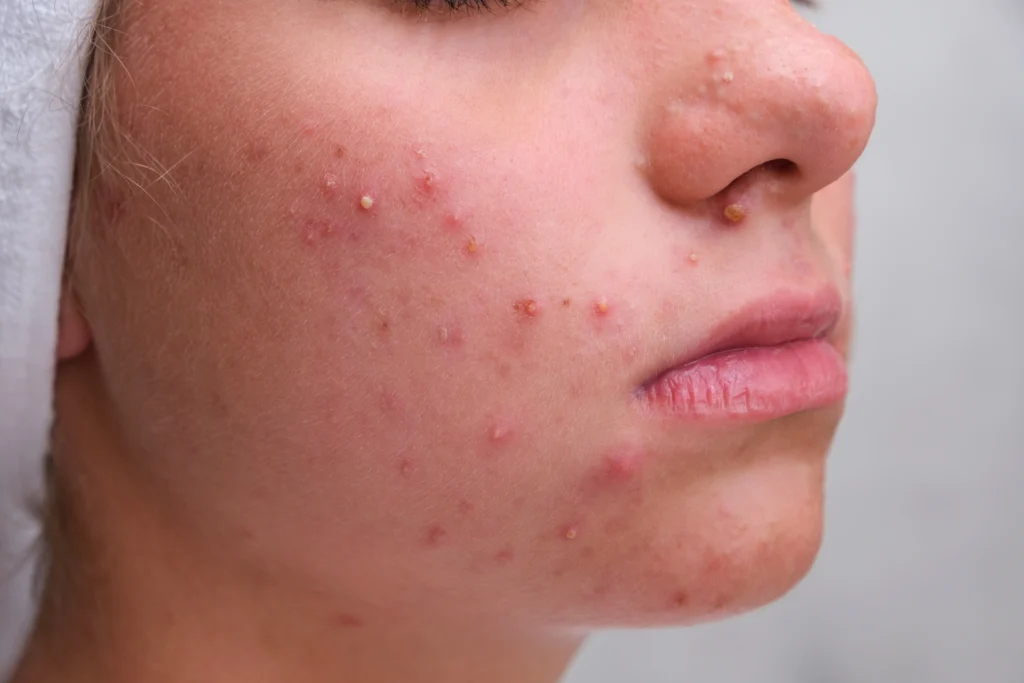 acne treatment