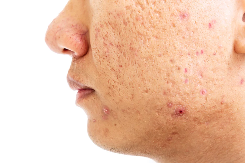 acne scar