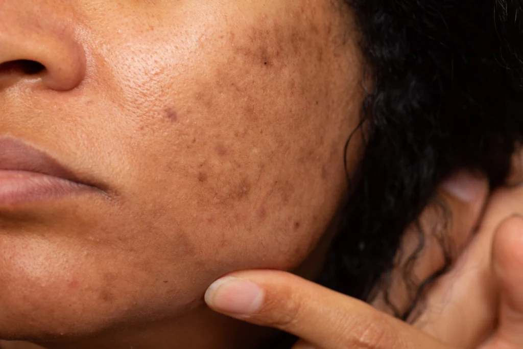 pigmentation treatment