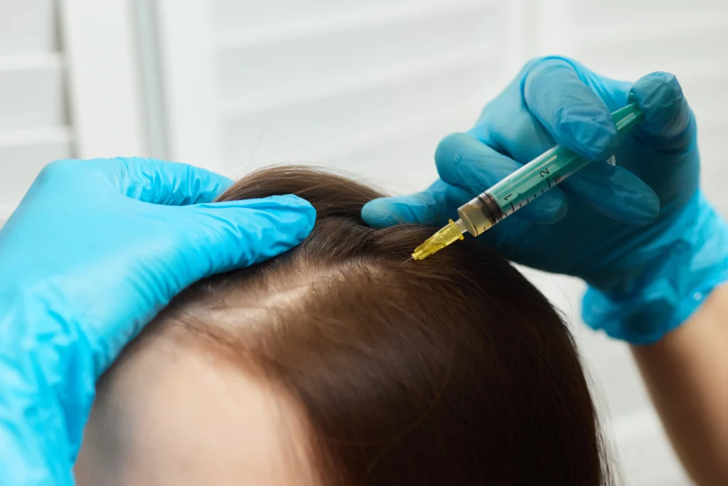 PRP treatment